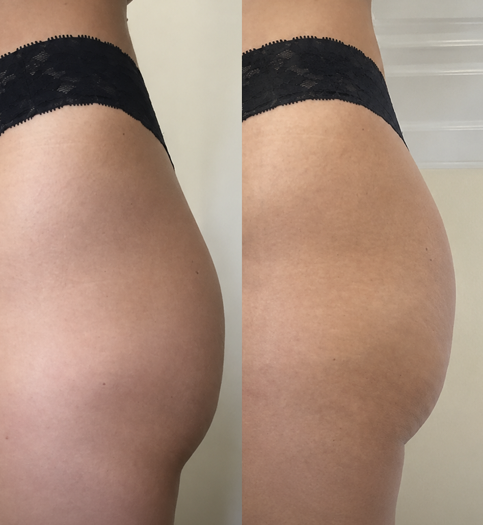 Resultado do Método Glúteo Up — antes e depois