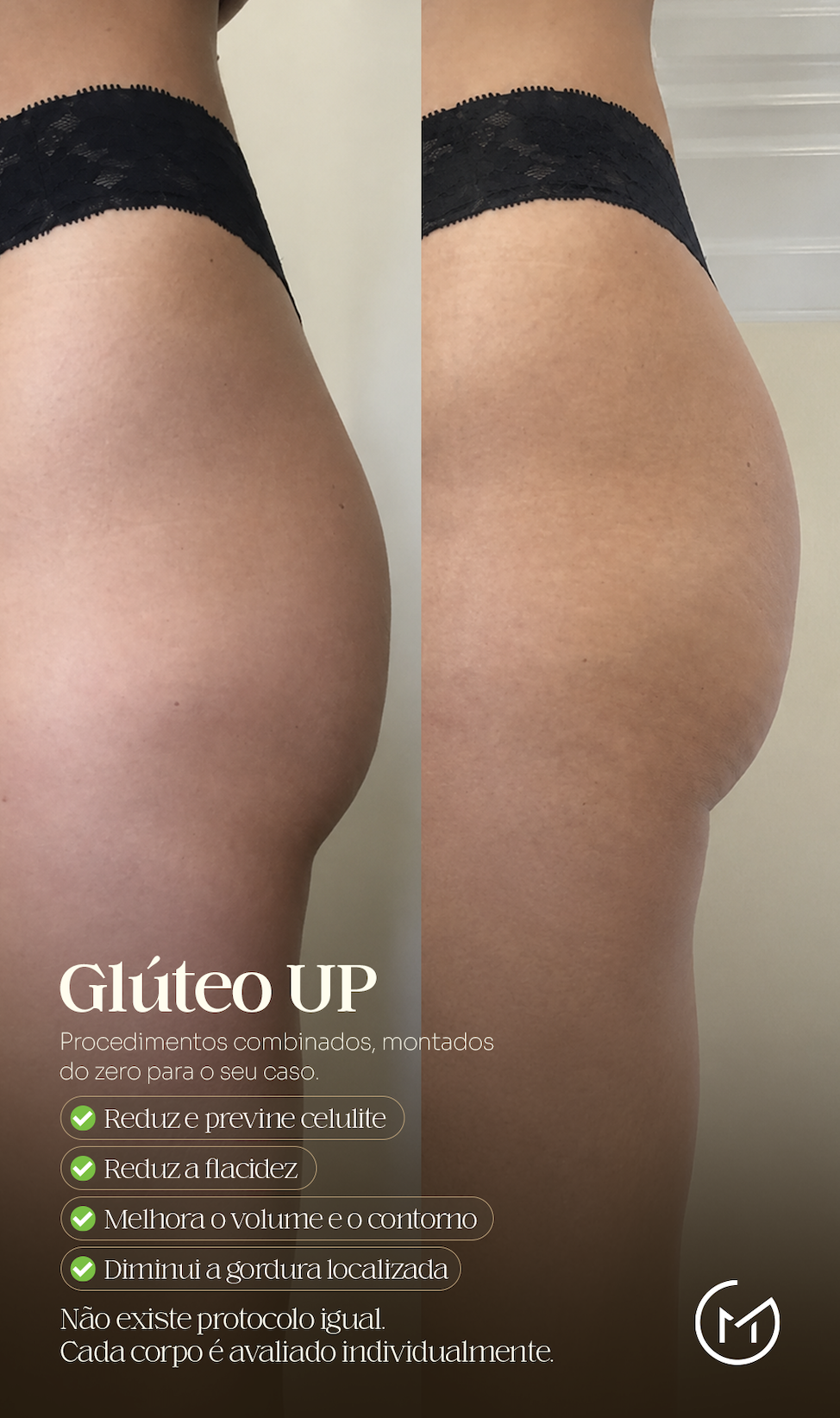 Resultado do Método Glúteo Up: evolução natural na firmeza e curva do glúteo