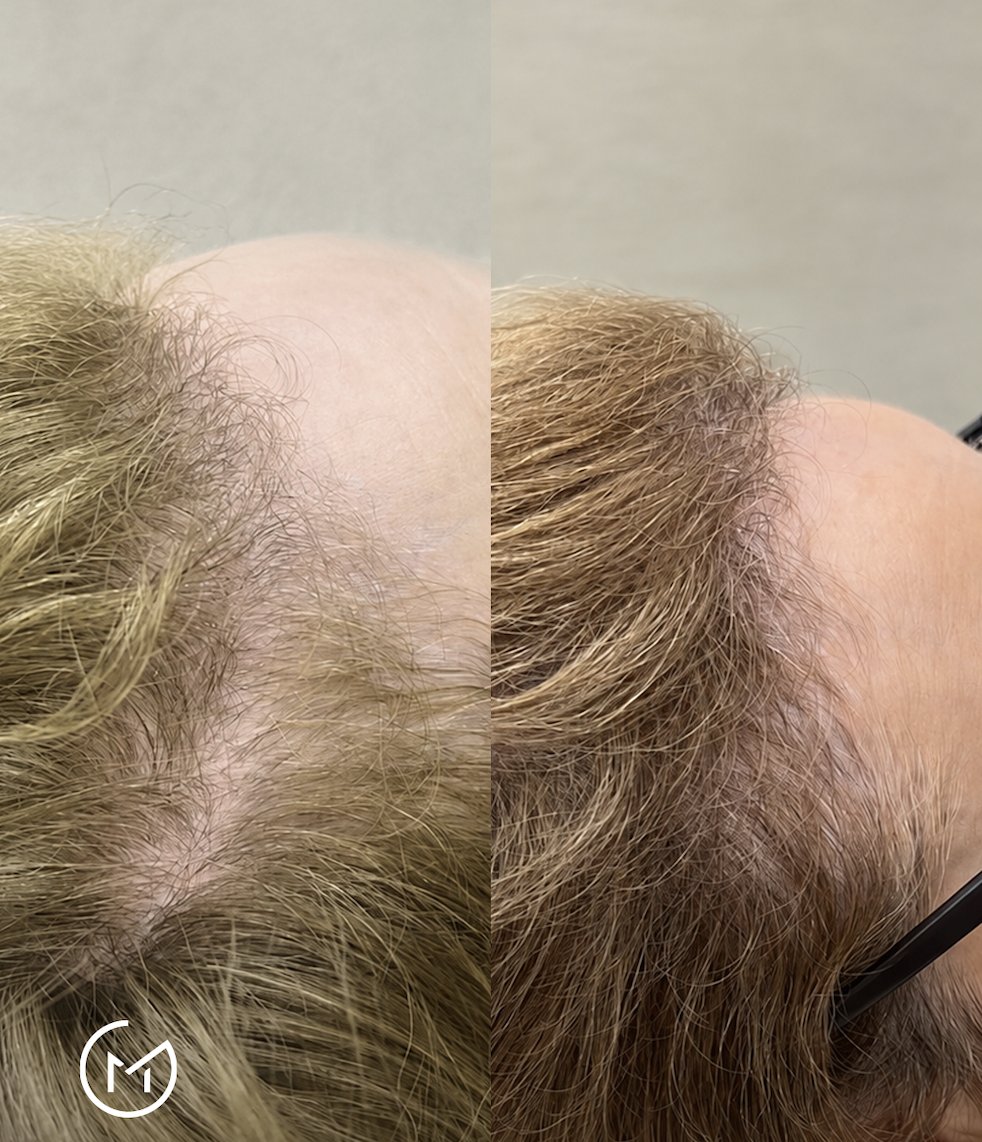 Resultado do Método Capilar — antes e depois